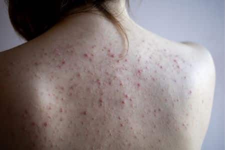 10 Common Causes of Red Spots on the Skin